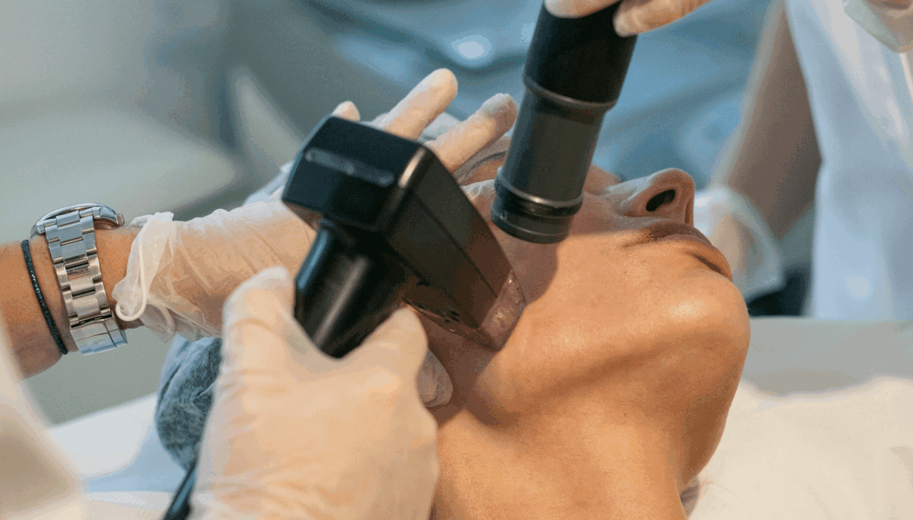 Rejuvenecimiento facial con radiofrecuencia y microagujas