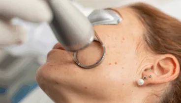 sesion de laser para mejorar el tono y textura de la piel