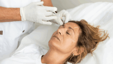 Tratamiento facial con botox para reducir líneas de expresión