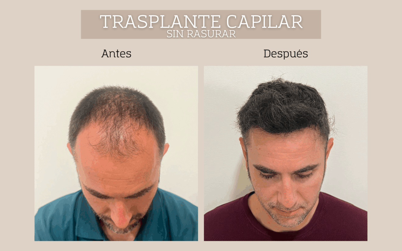 Antes y después del tratamiento capilar