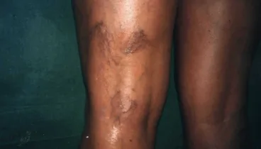 beneficios de mejorar la circulacion en las piernas