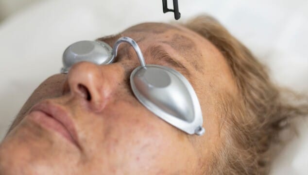 renueva el rostro con el peeling hollywood de policlinica cume