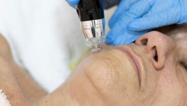 ¿Por qué la biorevitalización es más que un simple tratamiento estético? 55 tratamiento de biorevitalizacion en policlinica cume