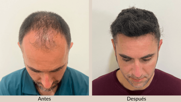 Dermadenia apuesta por el trasplante capilar sin rasurar 2 Imagen: Resultados naturales con injerto capilar