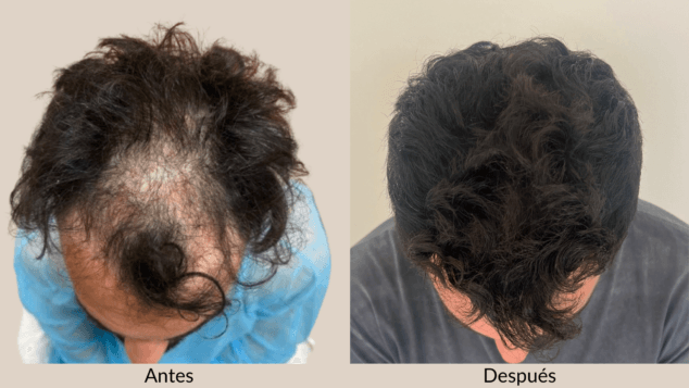 Dermadenia apuesta por el trasplante capilar sin rasurar 1 Imagen: Dermadenia apuesta por el trasplante capilar sin rasurar