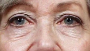 La piel pierde elementos clave como el colágeno, la elastina y el ácido hialurónico