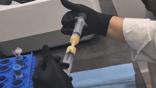 La medicina regenerativa da un paso más: la tecnología que transformará tu rostro antes y durante el verano 8 Imagen: Obtención del plasma en Clínica Doctora Flores de Apodaca