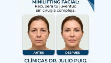 Minilifting Facial