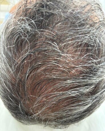 Alopecia androgenética a los 3 meses del tratamiento