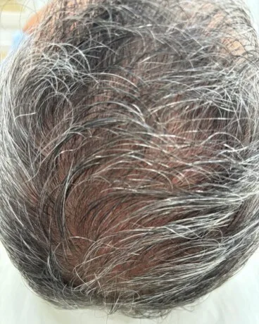 Alopecia androgenética a los 3 meses del tratamiento