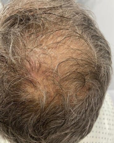 Alopecia androgenética antes de iniciar el tratamiento