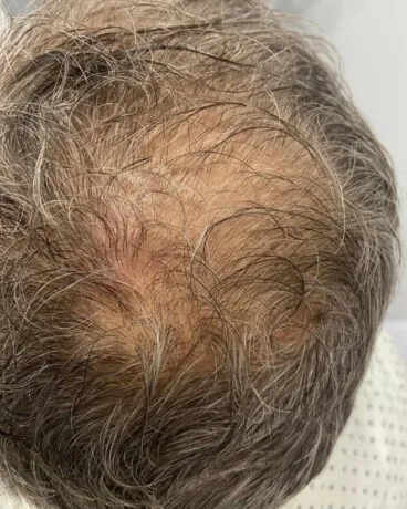 Alopecia androgenética antes de iniciar el tratamiento