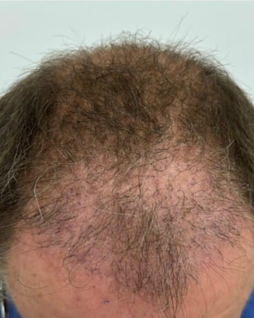 Alopecia androgenética antes de iniciar el tratamiento