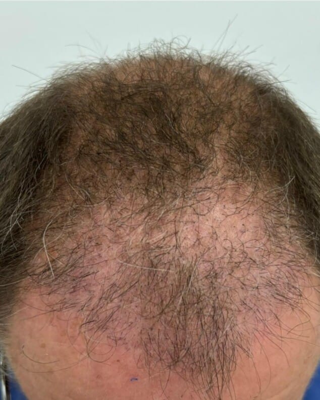 alopecia androgenetica antes de iniciar el tratamiento