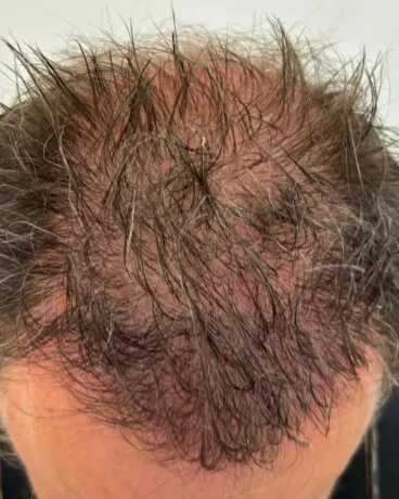 Alopecia androgenética tras finalizar el tratamiento