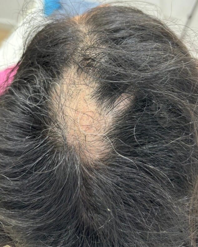 alopecia areata en mujer joven a los 3 meses del tratamiento 1