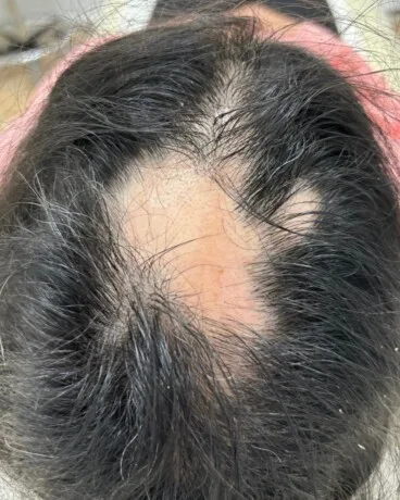 Alopecia areata en mujer joven al inicio del tratamiento