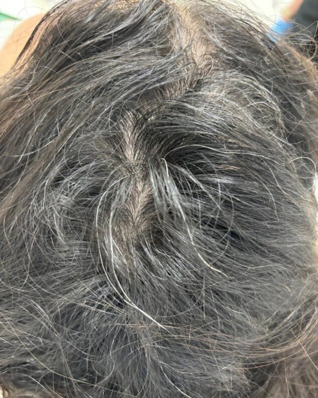 alopecia areata en mujer joven tras medio ano de tratamiento 1