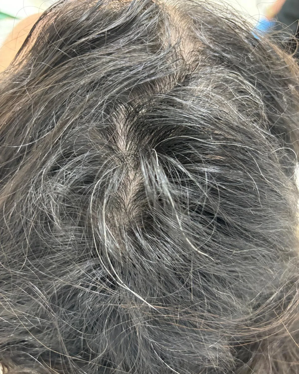 Alopecia areata en mujer joven tras medio año de tratamiento