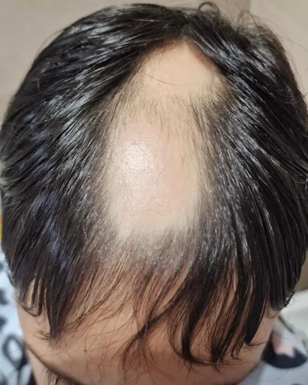 La clave para frenar la caída del cabello está en un diagnóstico personalizado 9 resultados tras 4 meses de tratamiento