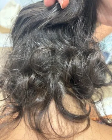 Tras 1 año de tratamiento la paciente recuperó el cabello