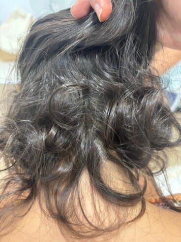 Tras 1 año de tratamiento la paciente recuperó el cabello