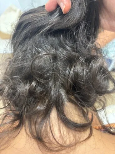 Tras 1 año de tratamiento la paciente recuperó el cabello