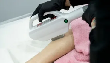 Depilación láser médica