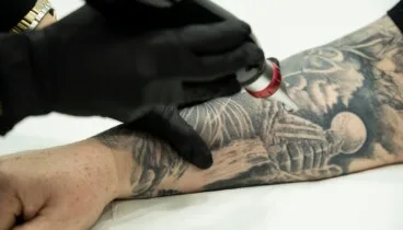 Eliminación de tatuajes con picoláser