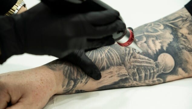 Otoño: buena época del año para retomar o comenzar muchos tratamientos 6 eliminacion de tatuajes con picolaser