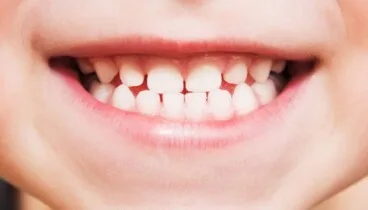 Caries en niños: los 4 factores que aumentan el riesgo 7 higiene bucodental infantil