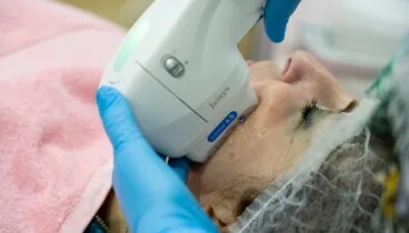Luz pulsada para tu cutis